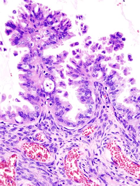 borderline tumor of ovary